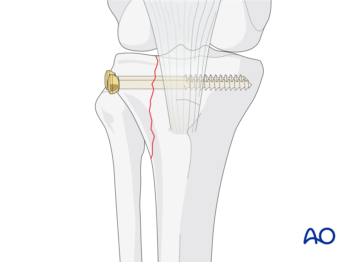 Proximal tibia lateral plateau split fracture with ORIF and lag screw fixation