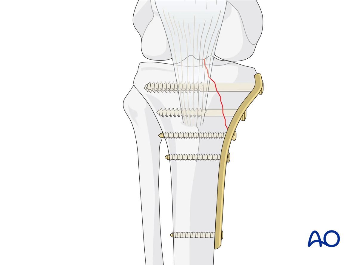 ORIF - Conventional plating, partial articular fracture split medial