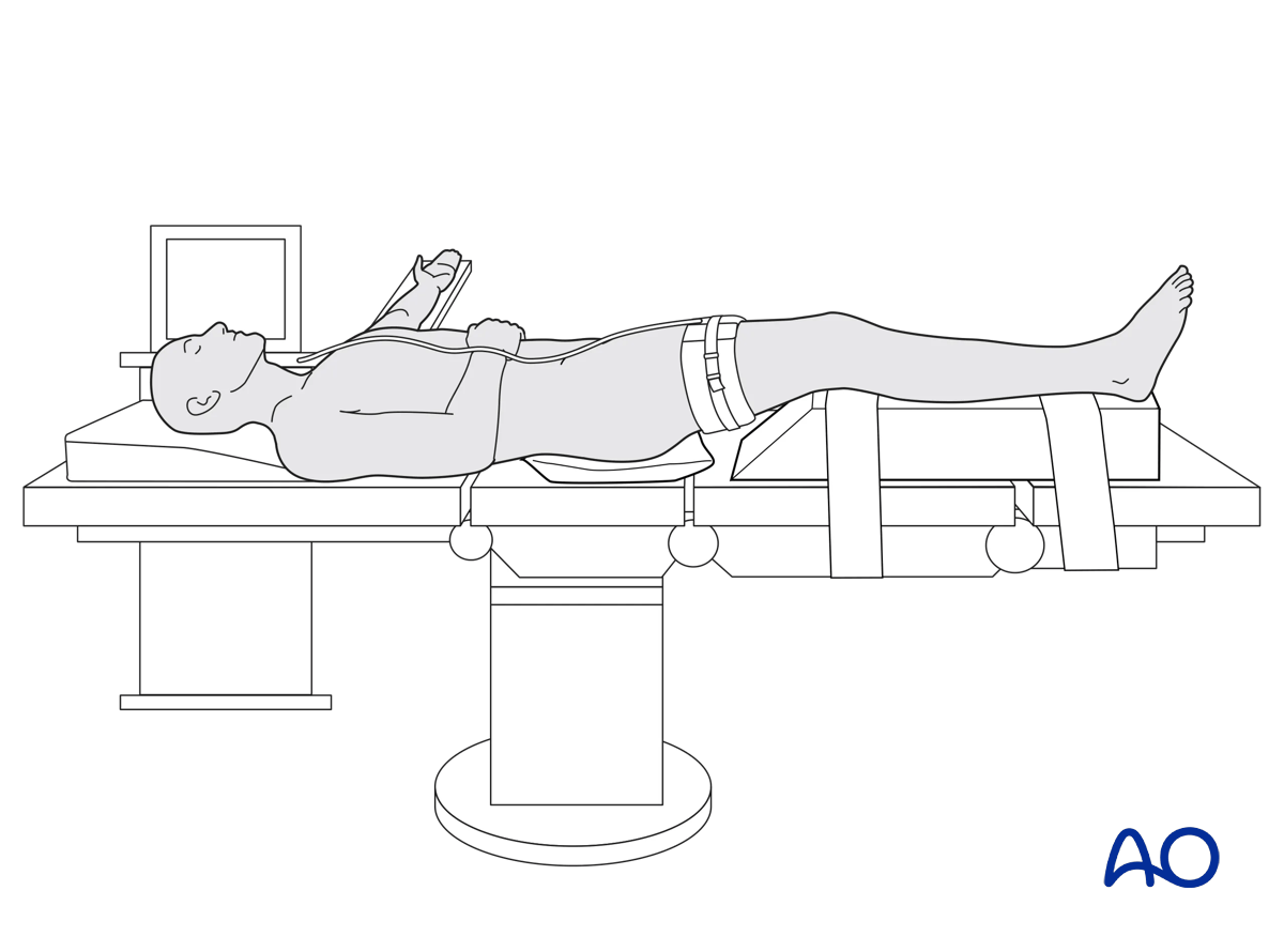 supine position, tourniquet