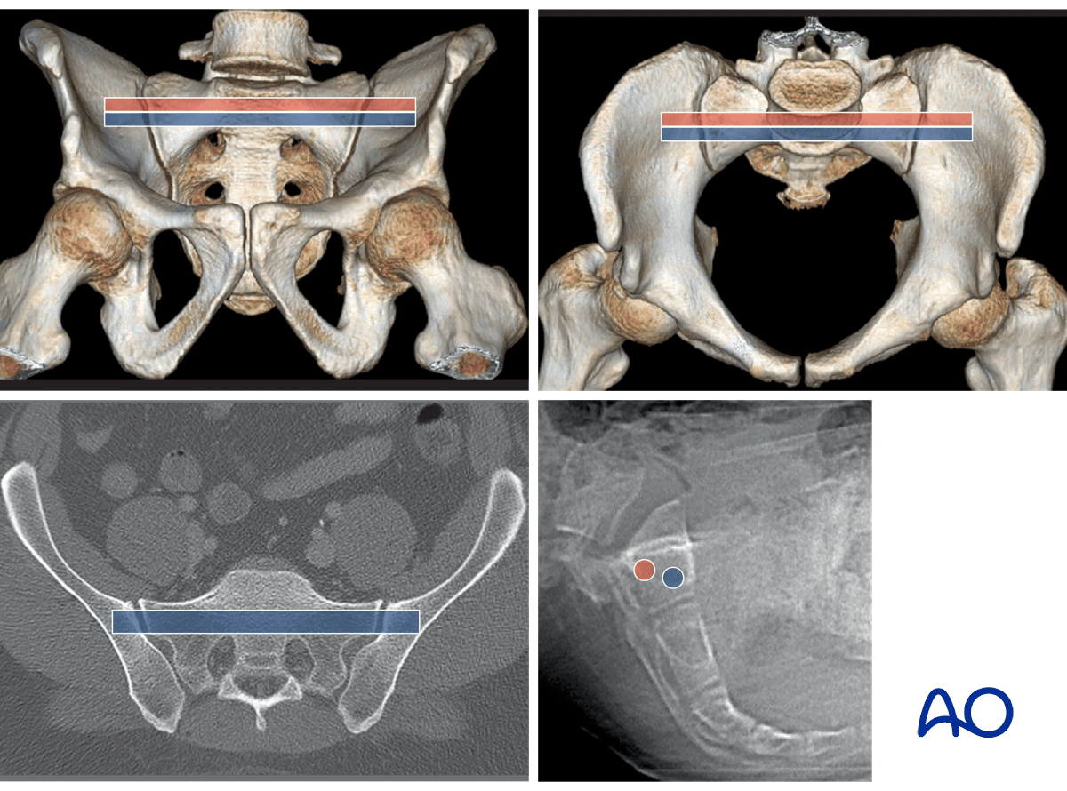 MIO iliosacral screw for sacrum
