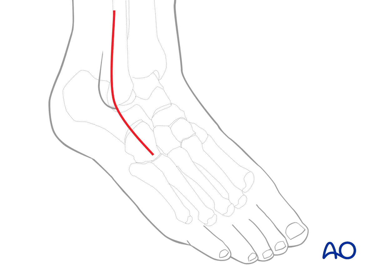 Lateral malleolar osteotomy full-thickness longitudinal incision avoids superficial peroneal nerve branches