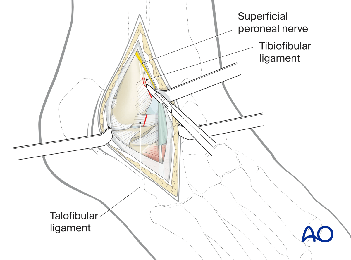 Lateral malleolar osteotomy incise anterior distal tibiofibular and talofibular ligaments