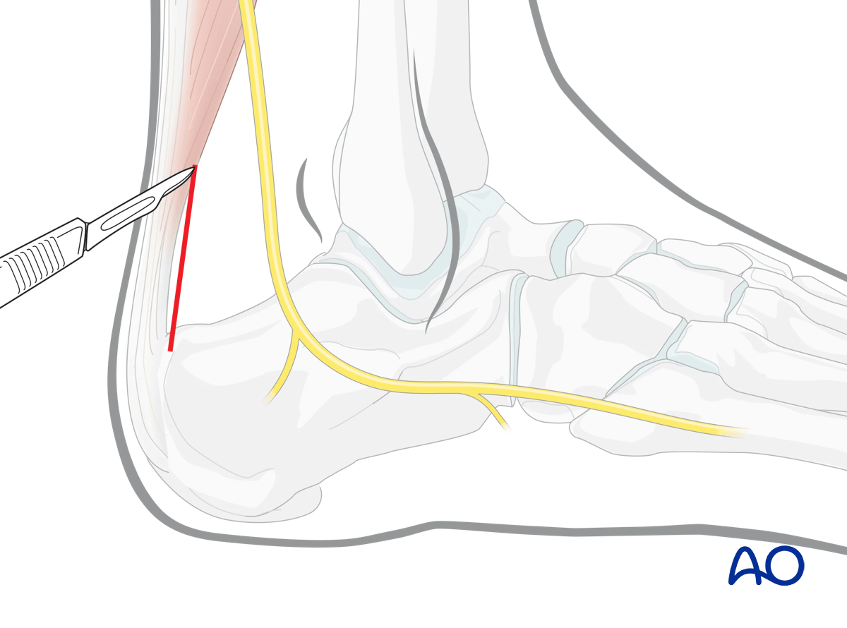 Posterolateral approach hindfoot: access to posterior talus for fractures, nonunion, stabilization.