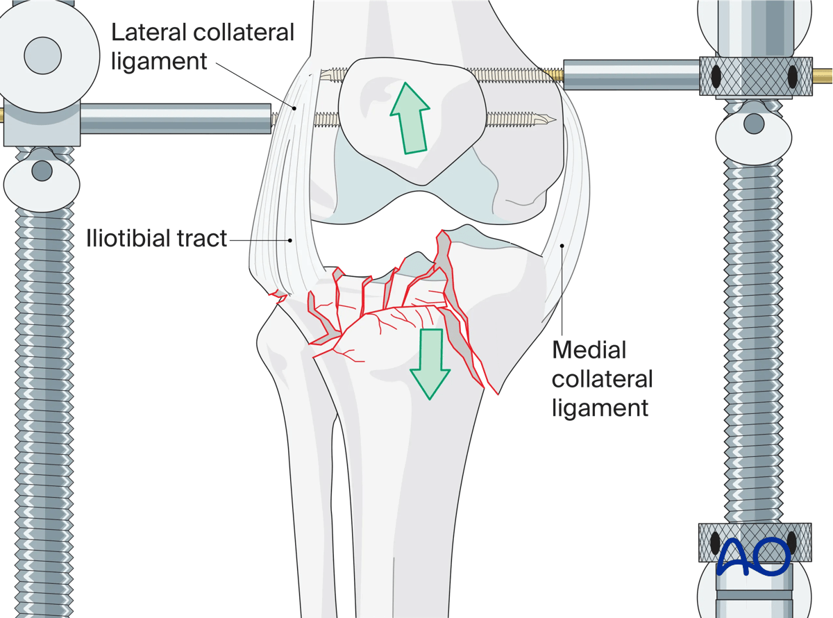 ORIF - Conventional plating, preliminary reduction