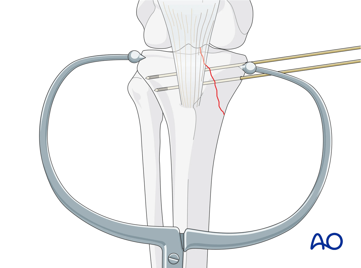 ORIF - Conventional plating, reduction of medial articular surface