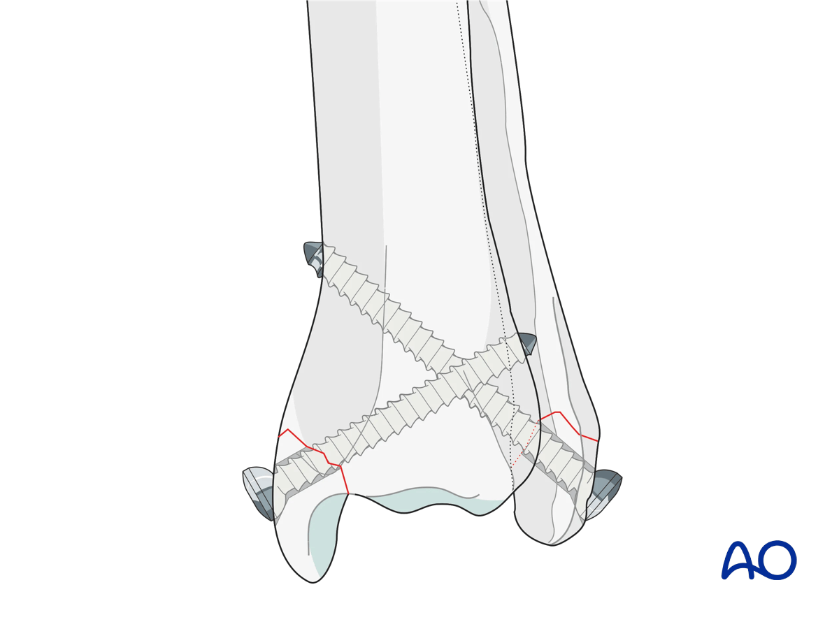 Screw fixation of the medial and lateral malleoli for Partial articular ...