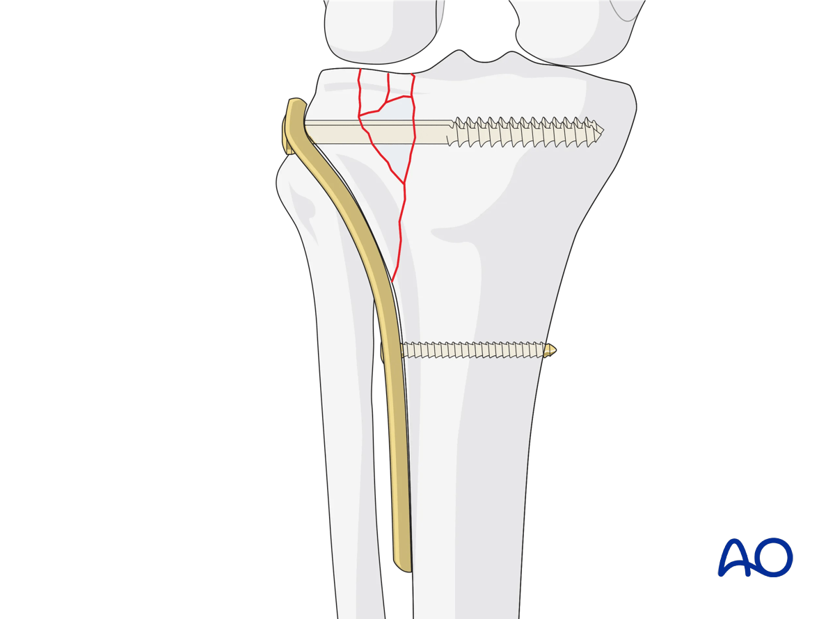 Proximal tibia Lateral plateau split-depression fracture – ORIF conventional plating – fixation of the lateral column