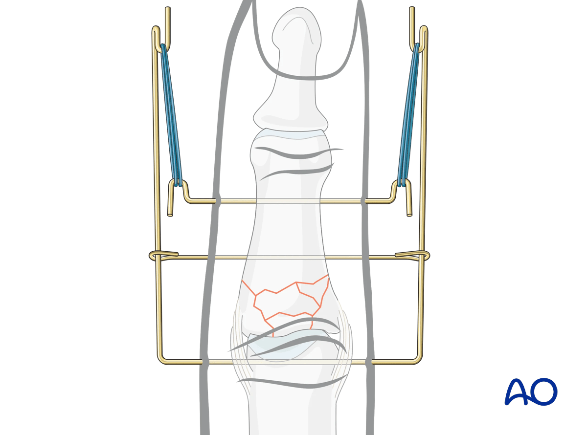 Dynamic external fixation: Insert third K-wire distal to fracture zone, parallel to others, palmar to first K-wire legs; bend ends around legs.