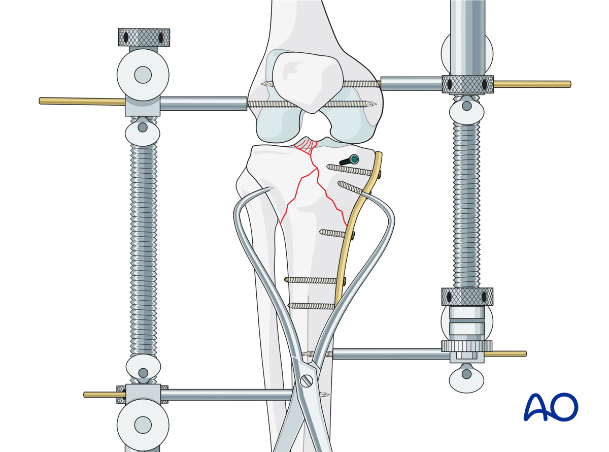 Proximal tibia - Complete articular fracture with fragmentary medial plateau: reduction of lateral column