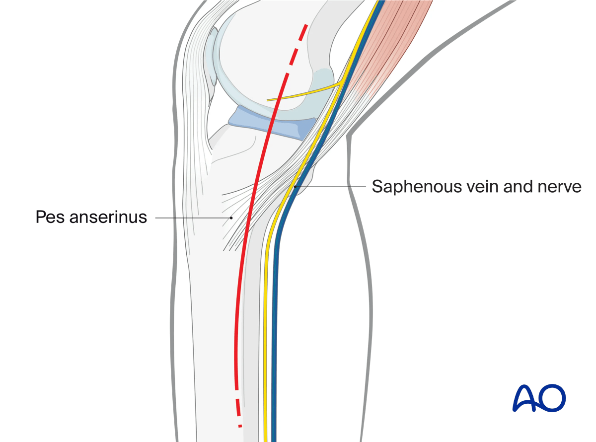 Medial/posteromedial approach to the proximal tibia, skin incision