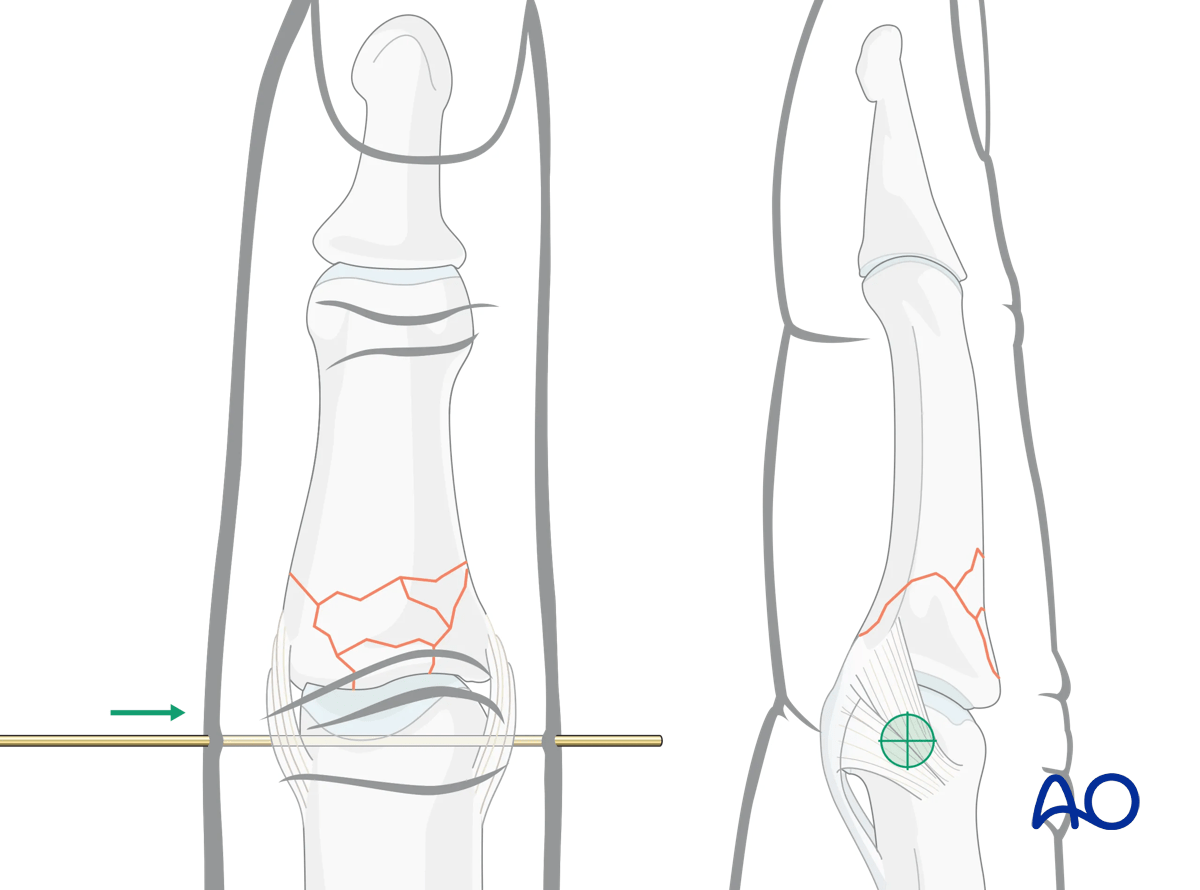Dynamic external fixation: Insert first 1.2 mm K-wire in center of rotation of proximal phalangeal condylar block under image intensification.