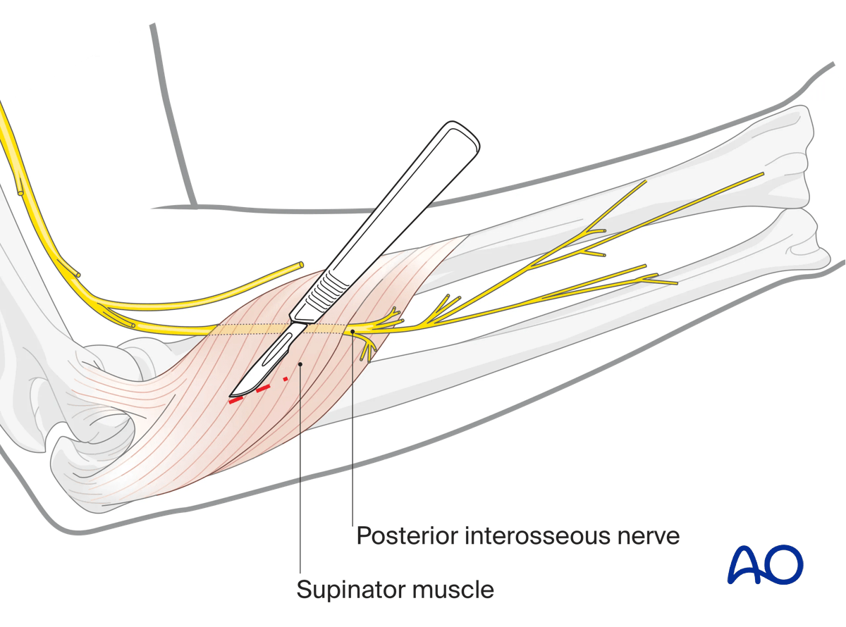 Illustration of forearm showing posterior interosseous nerve and supinator muscle
