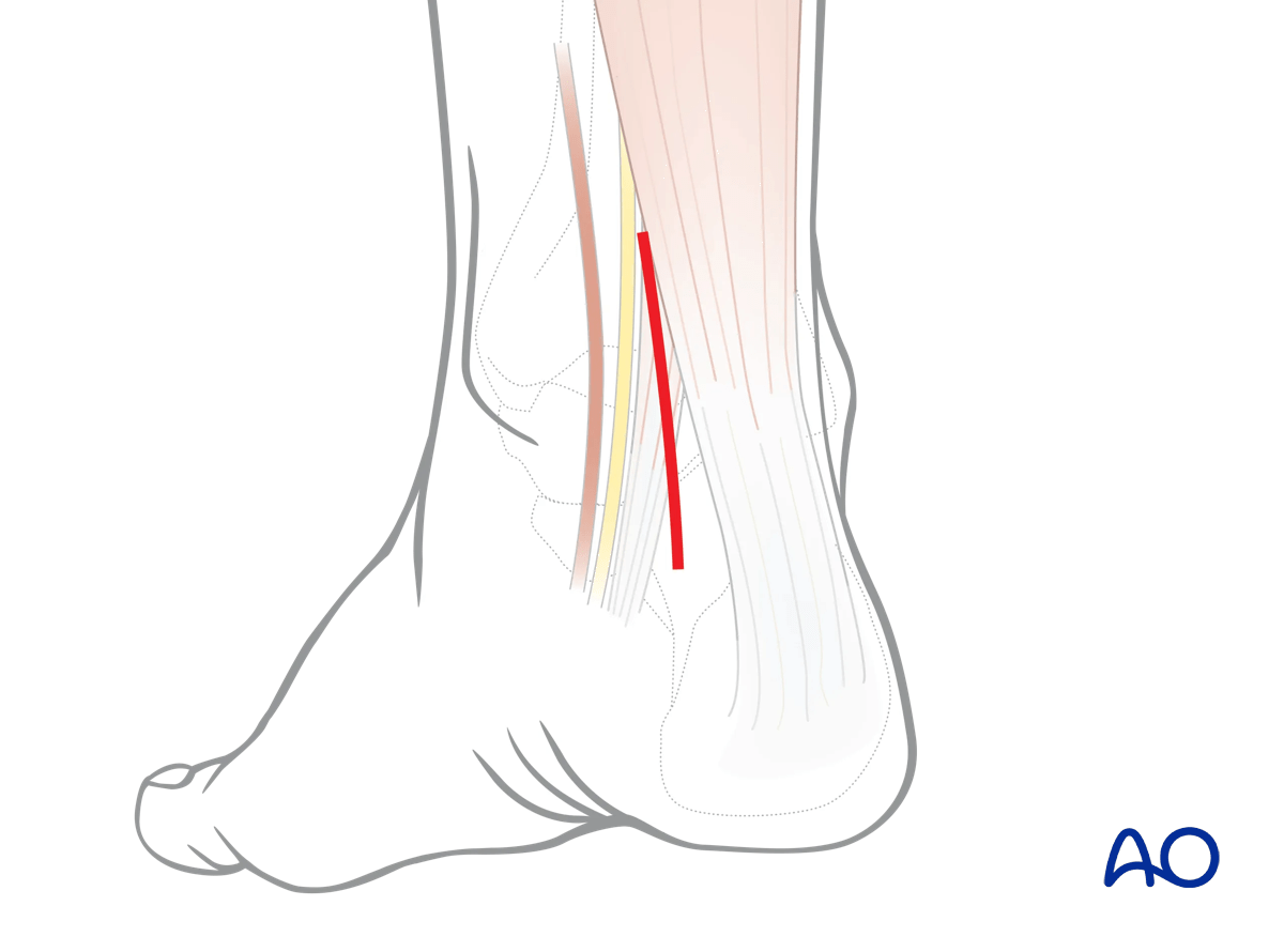 Posteromedial talus approach: exposure limited to posterior talus and ankle/subtalar joints