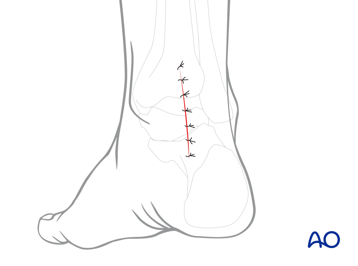 Posteromedial talus approach layered closure reconstructs deep tissues while protecting posterior tibial neurovascular bundle
