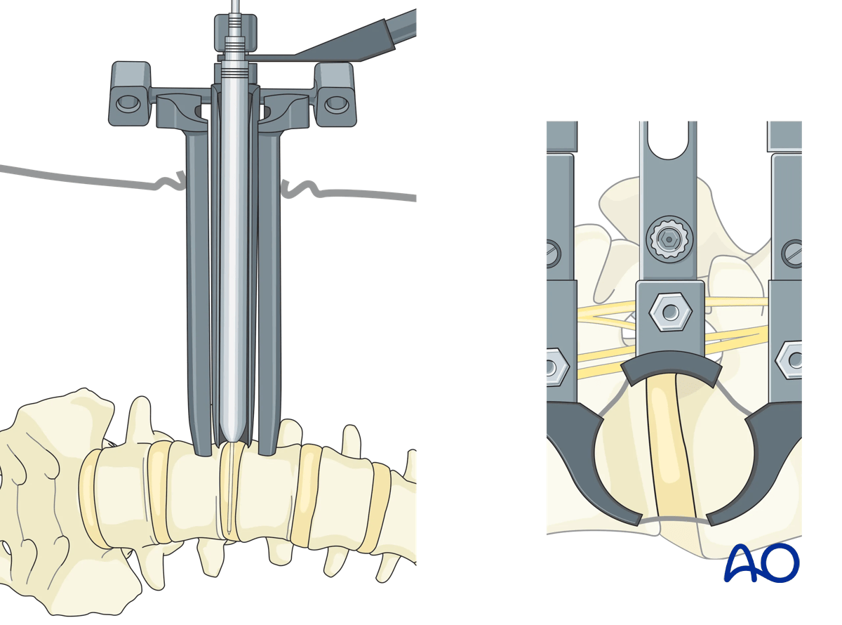 A self-retaining retractor system is highly recommended during Lateral lumbar interbody fusion (LLIF)