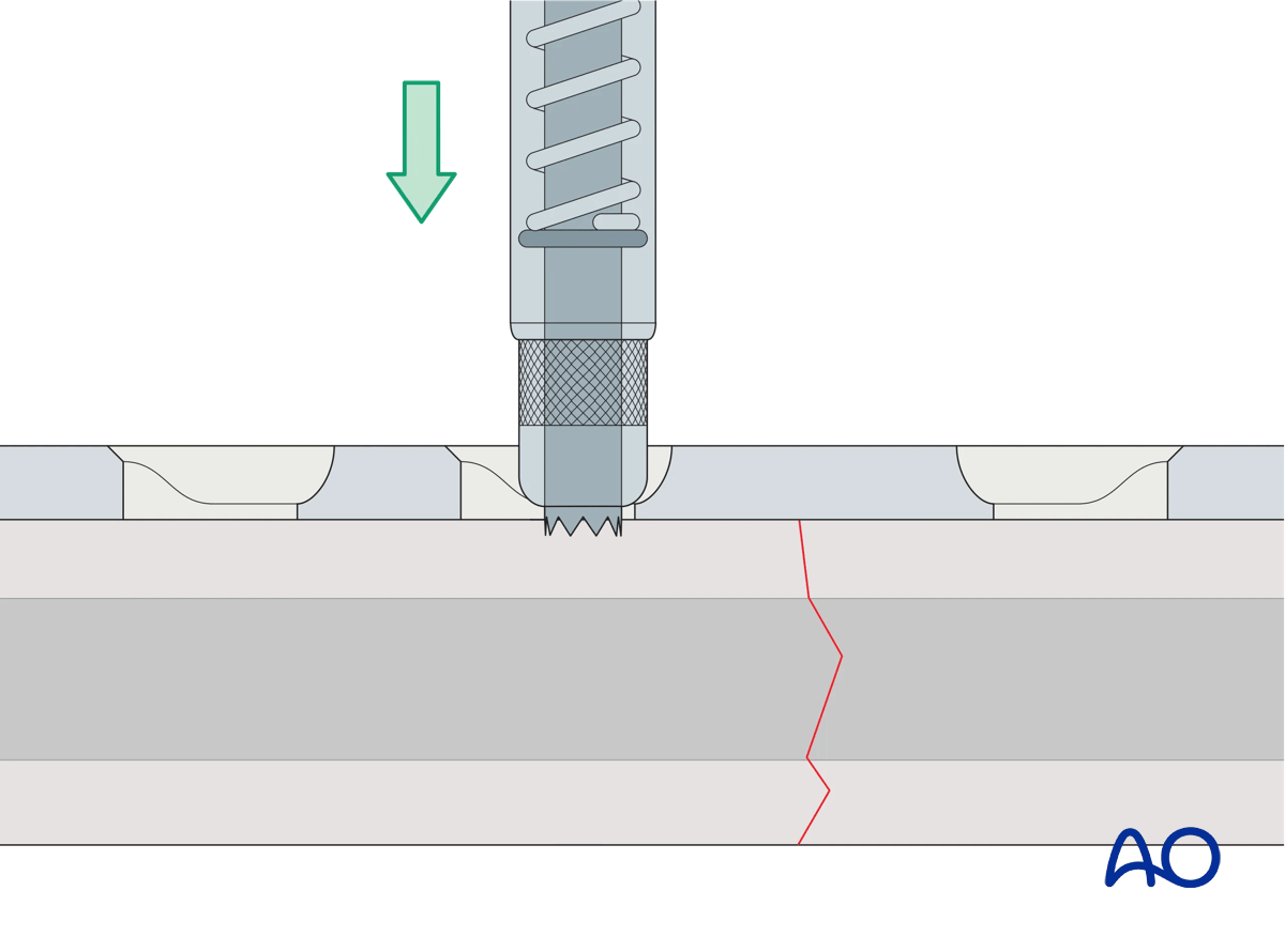 universal spring-loaded DCP drill guide