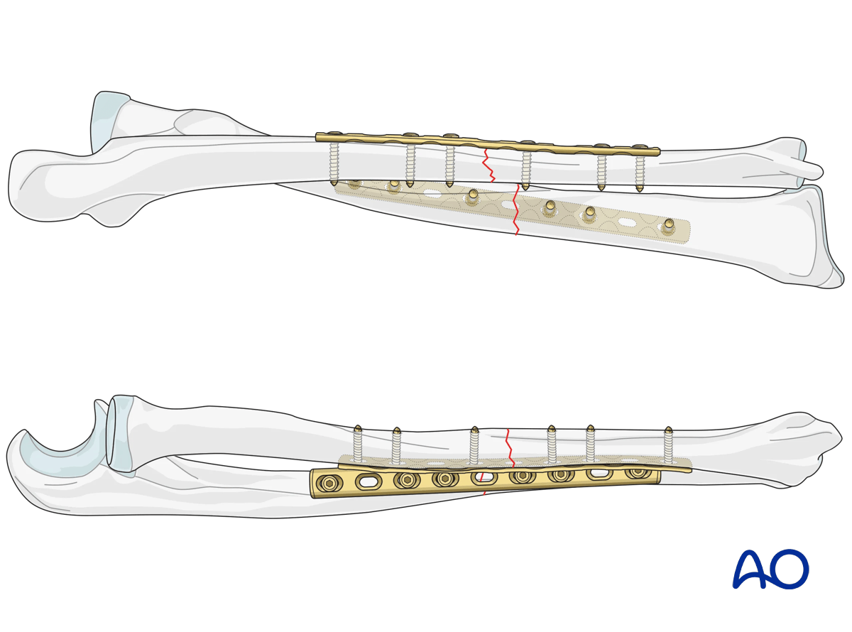 Plating of transverse fractures of both forearm bones