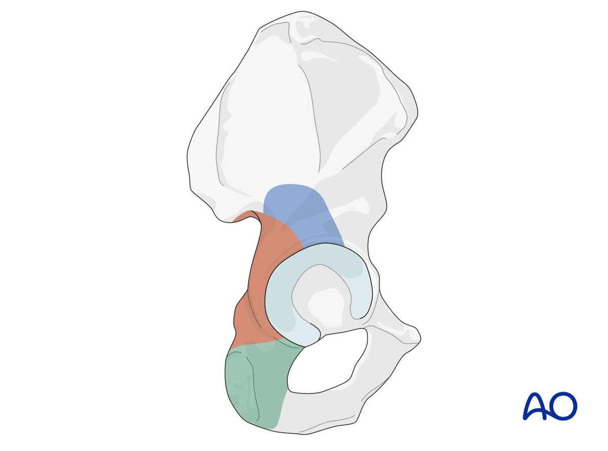 Direct access of the Kocher-Langenbeck approach to dark brown area, limited by neurovascular bundle; blue area via trochanteric osteotomy; green area via quadratus femoris reflection.