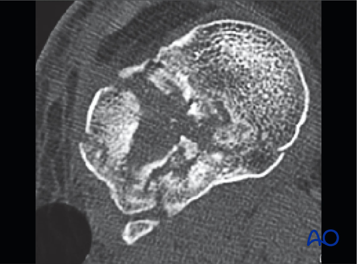 Proximal tibia - articular comminution and depression of the lateral tibial plateau