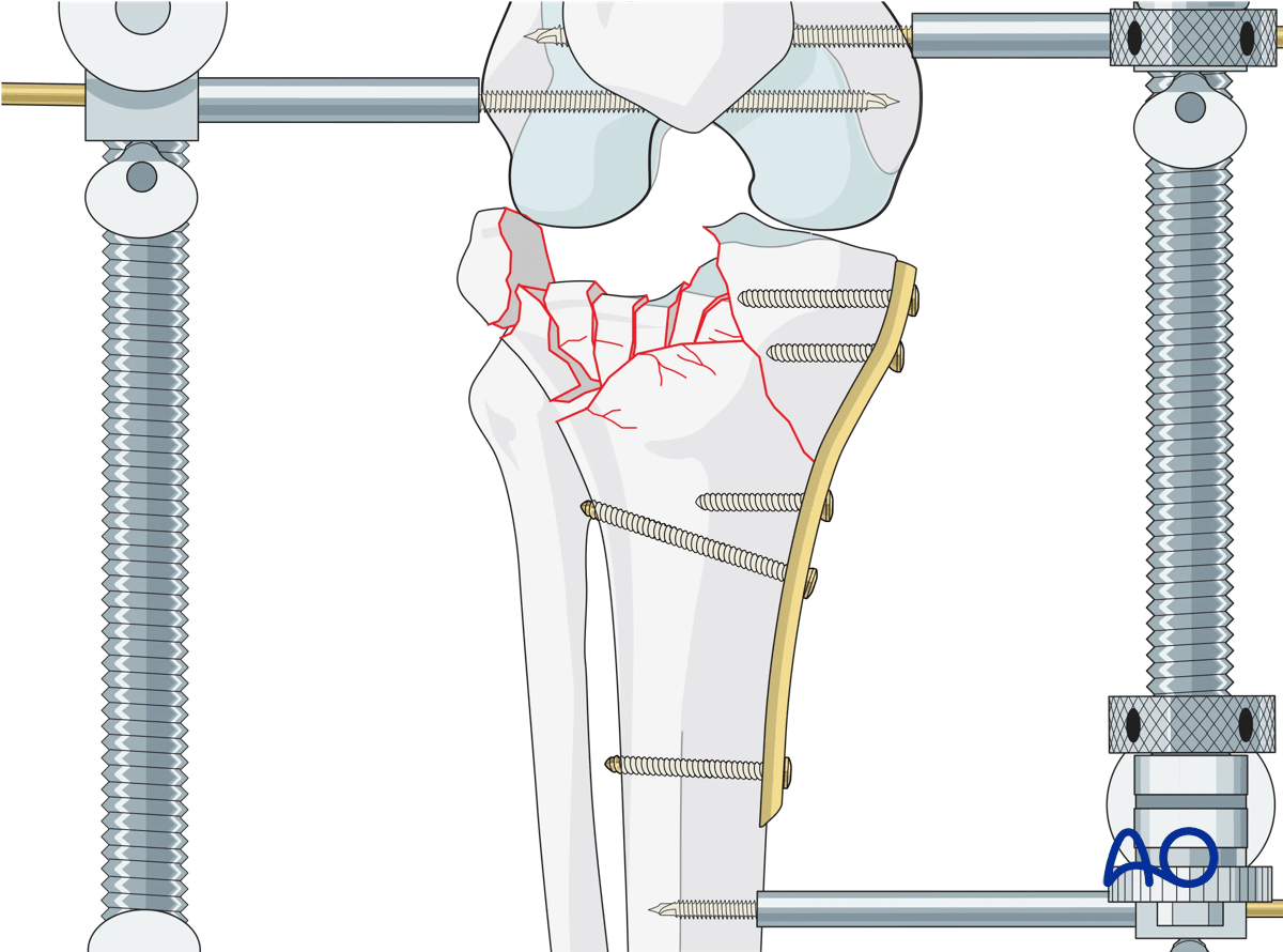 ORIF - Conventional plating, choosing the proper reduction sequence