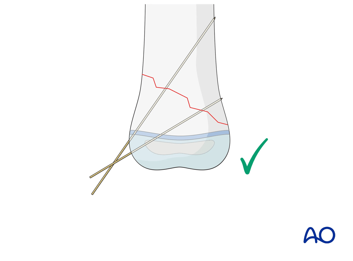 Monolateral divergent K-wires in oblique fractures