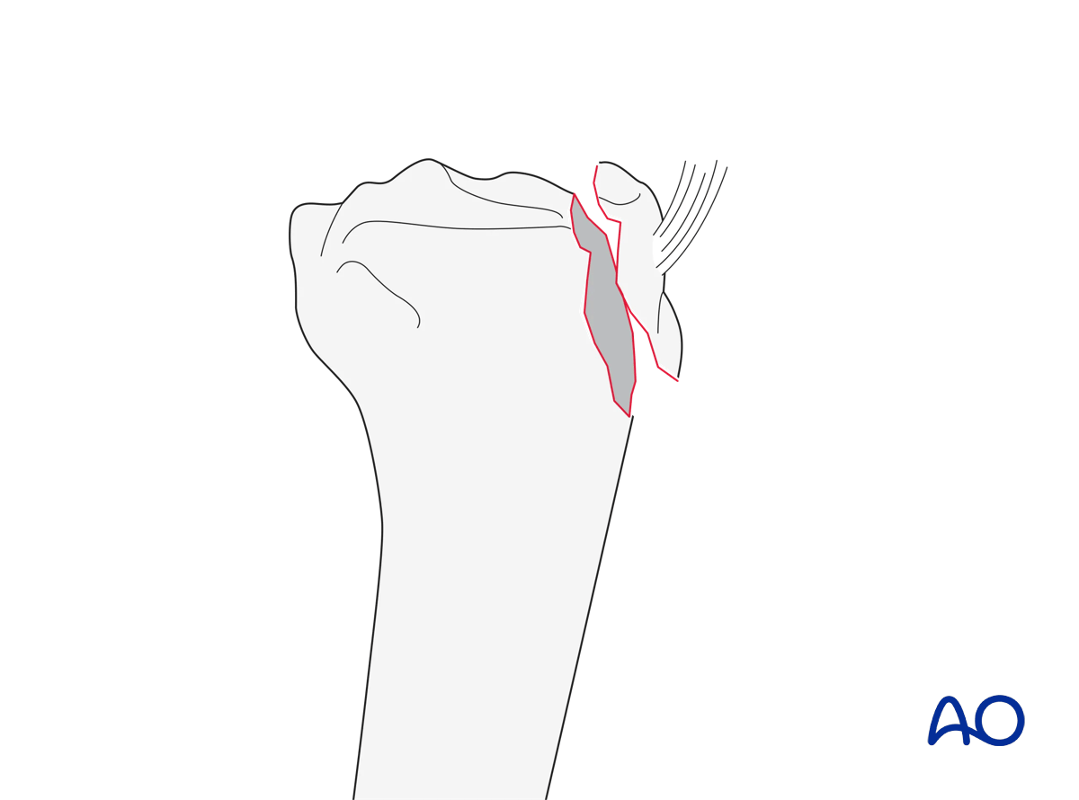 Tibial tubercle (AO/OTA 41A1.2)