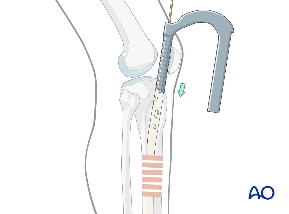 Suprapatellar intramedullary nailing, Insertion of the cannulated nail