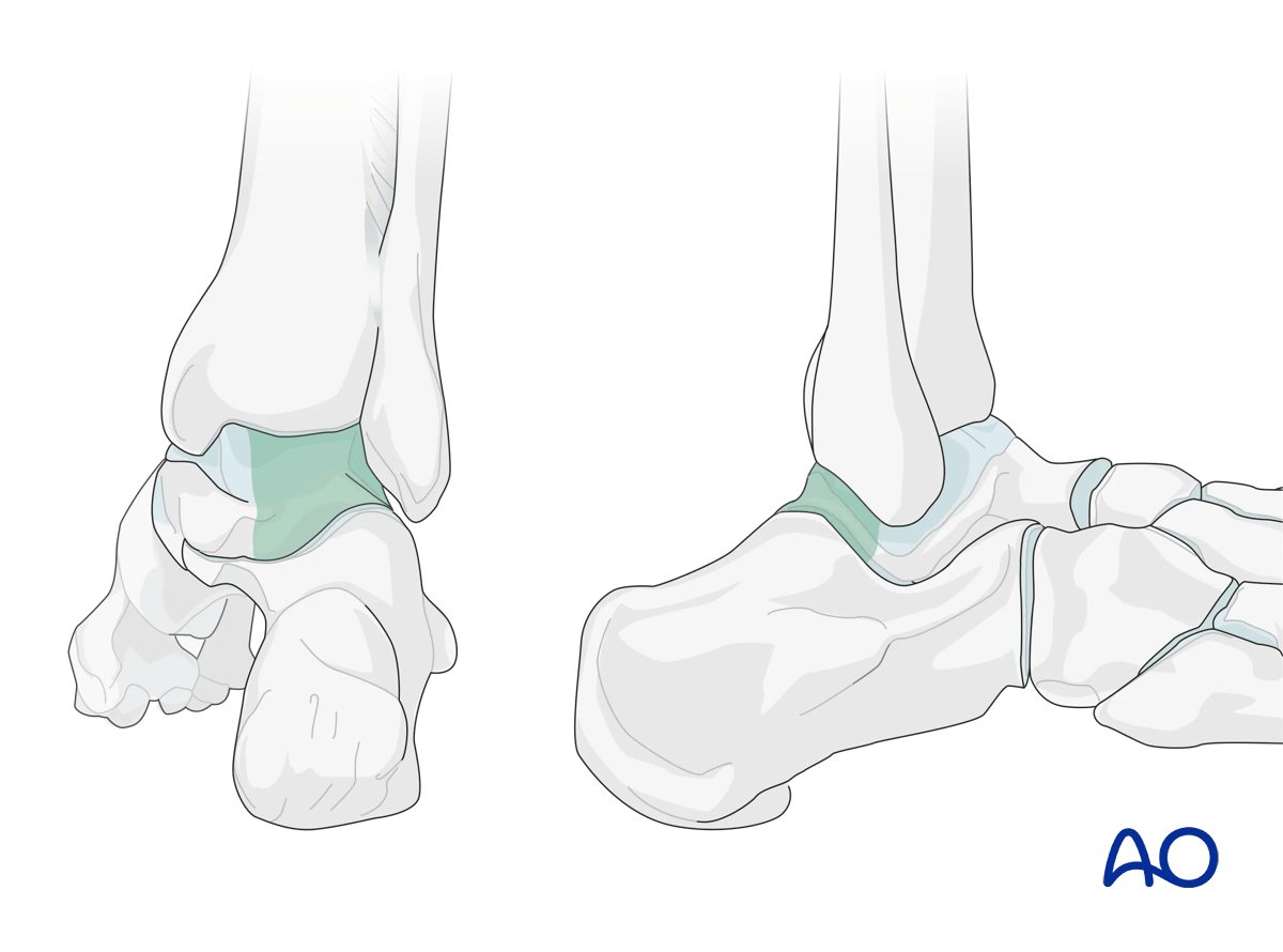 Areas of the talus visible through the posterolateral surgical approach.