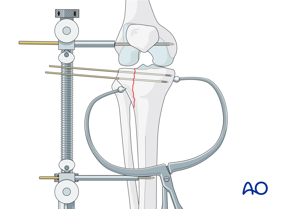 ORIF - Conventional plating, Reduction of the lateral articular surface
