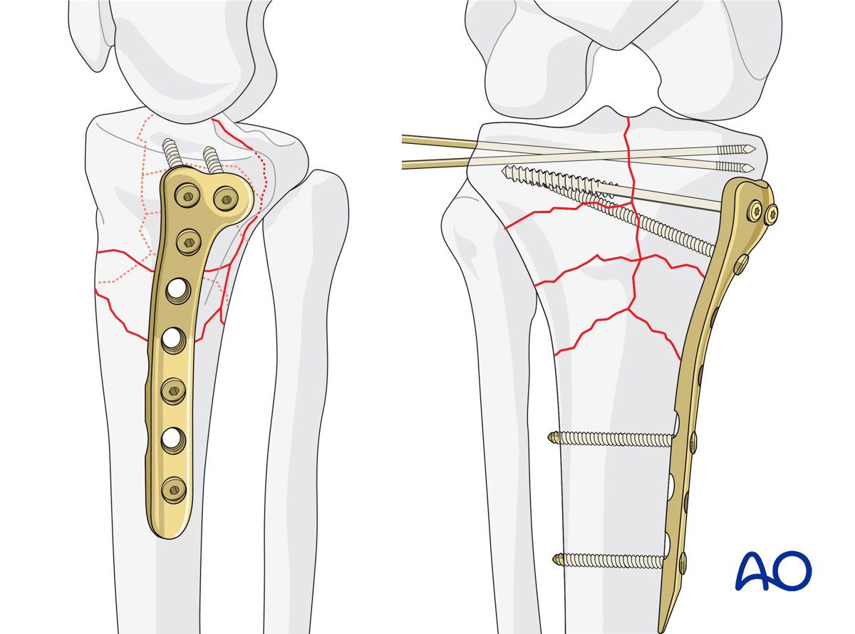 Complete simple articular fracture with fragmentary metaphyseal components: medial column fixation