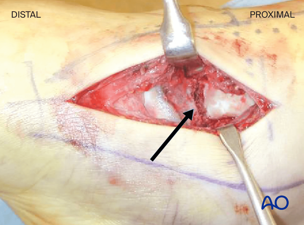 Anteromedial approach exposed inferomedial talar neck fracture after hematoma evacuation