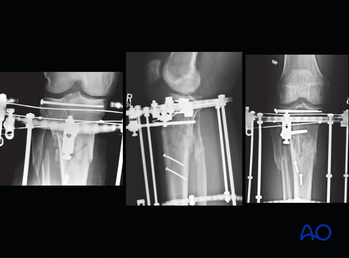 Proximal tibia fracture – ring fixation: a three-ring frame