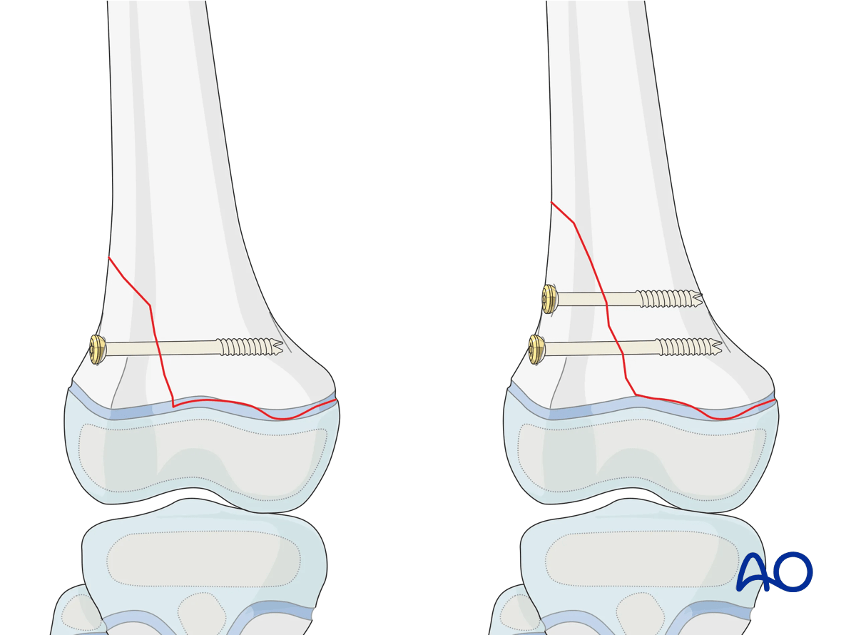 Screw fixation of a Salter-Harris type-II distal femoral fracture in a pediatric patient