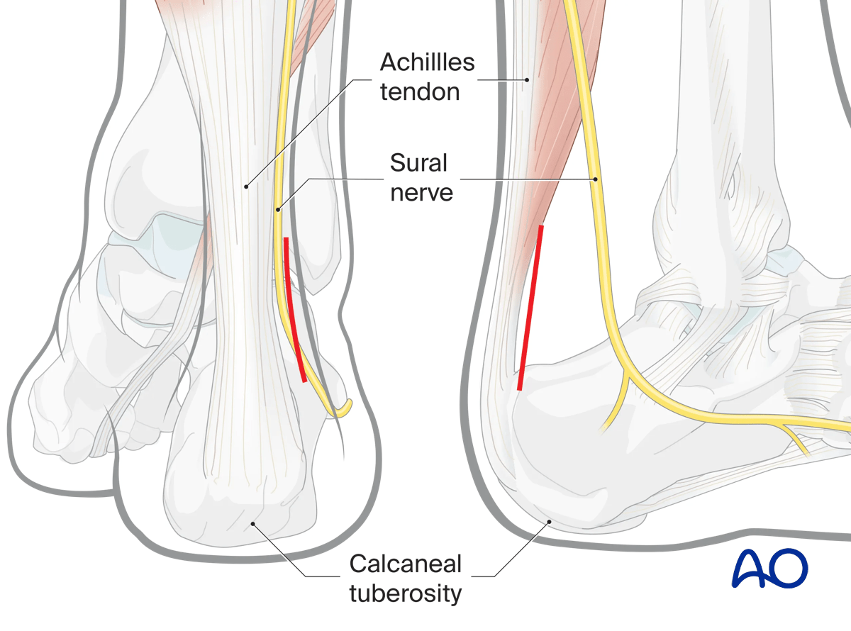 Posterolateral approach hindfoot incision landmarks: lateral Achilles border and calcaneal tuberosity; avoid over Achilles.