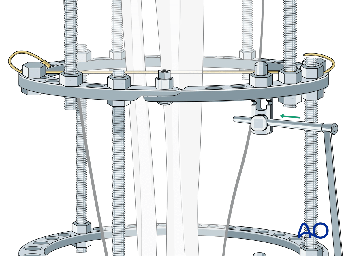 Proximal tibia fracture – ring fixation: Schanz screw mounting with multiparallel pin clamp