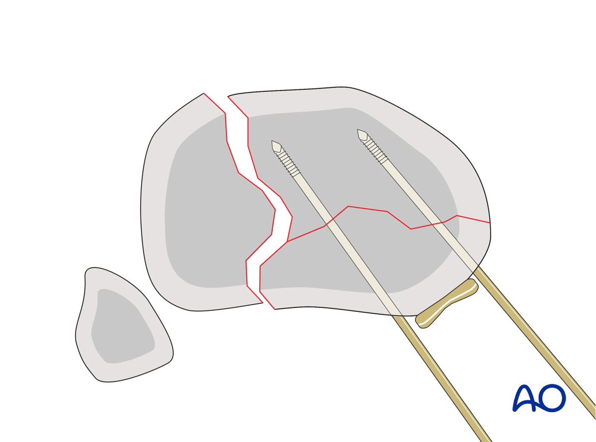 Proximal tibia - Transarticular coronal plane fracture