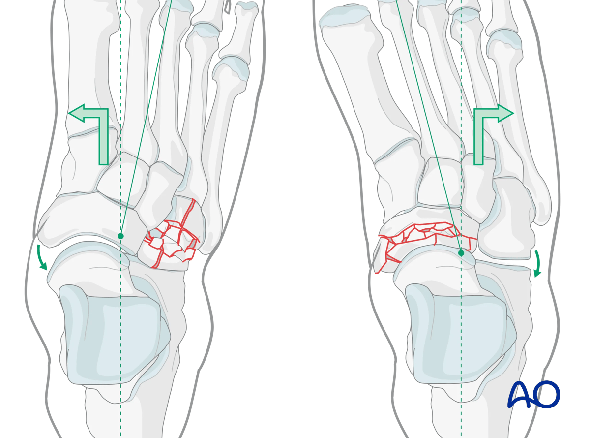 Closed reduction maneuvers of two types of Chopart injuries