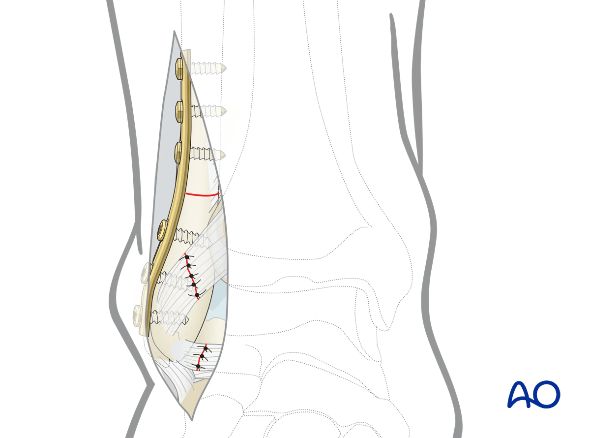 Lateral malleolar osteotomy reduce fibula; compress osteotomy with plate or screw/nail; repair distal tibiofibular ligament