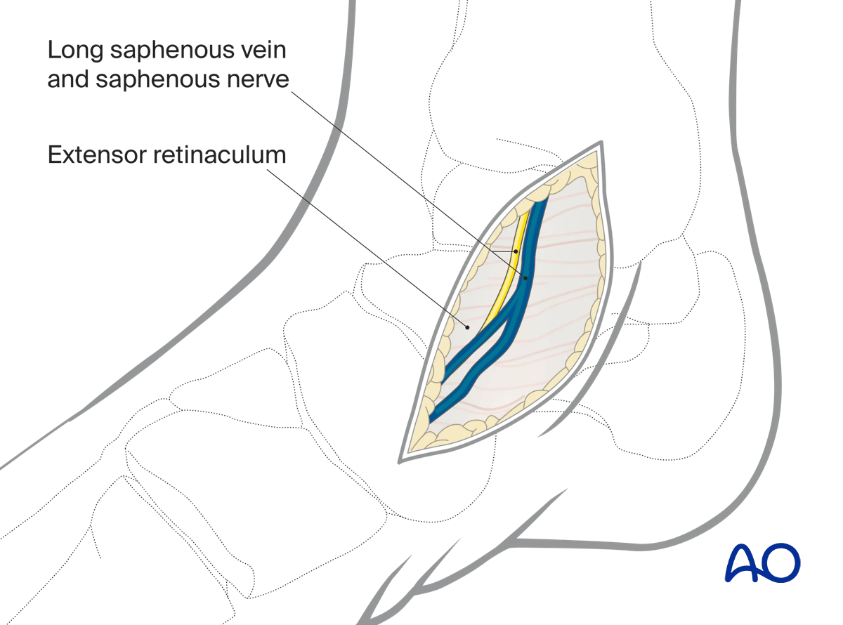 Anteromedial approach dissection showing saphenous vein and nerve near incision