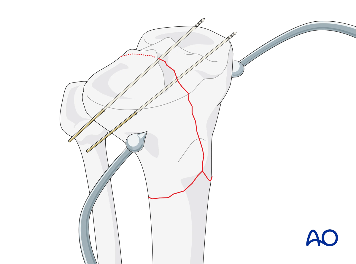 Complete simple articular fracture with simple metaphyseal components: ORIF Conventional plating – secure reduction