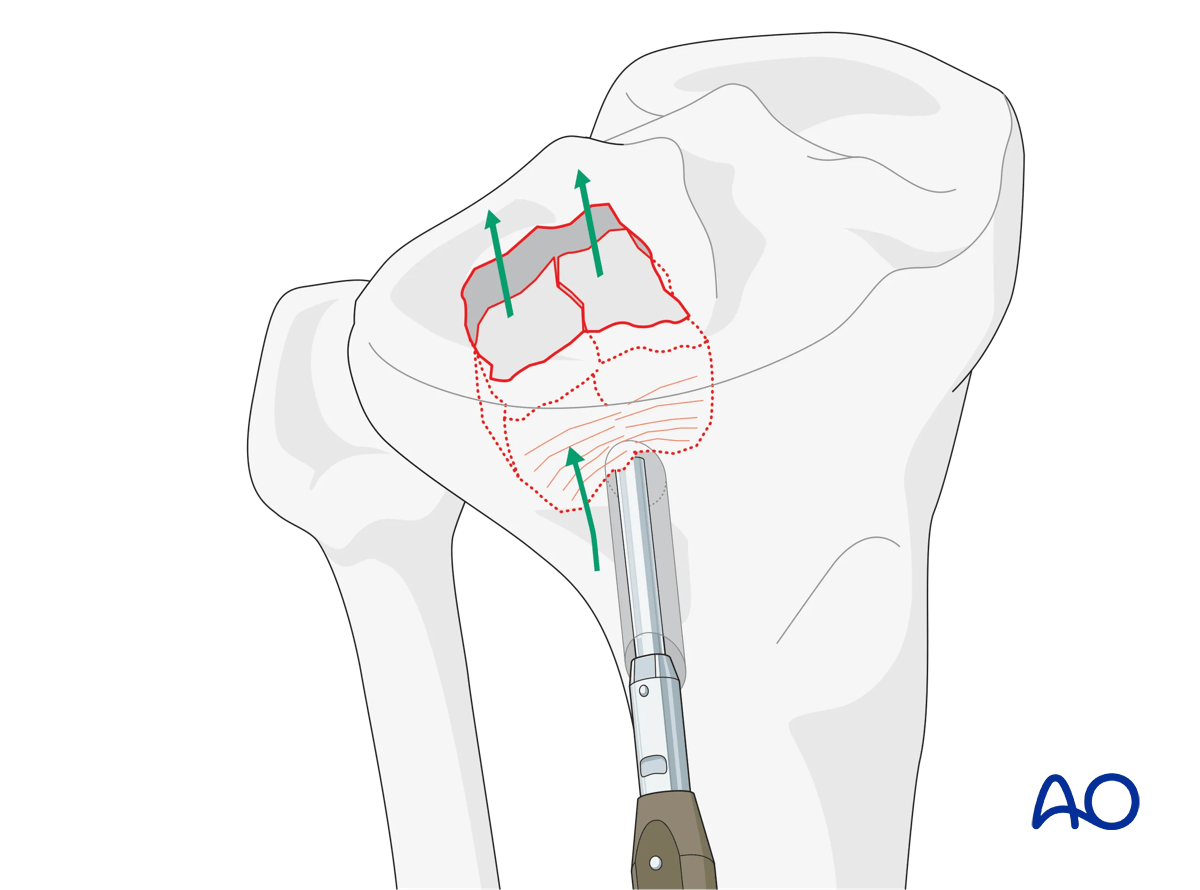 ORIF - Conventional plating, preliminary reduction