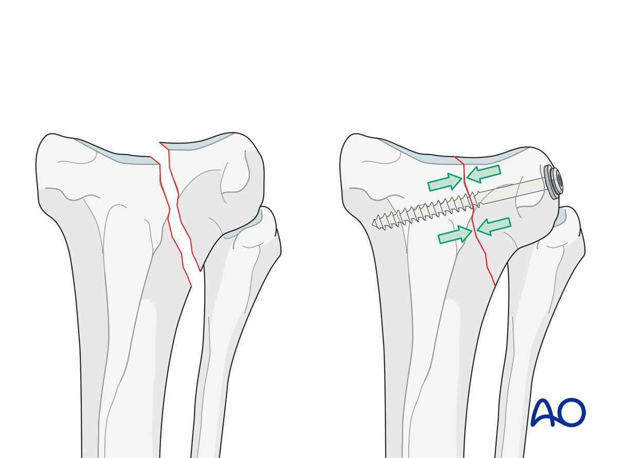 Cancellous screw fixation of a partial articular fracture of the proximal tibia