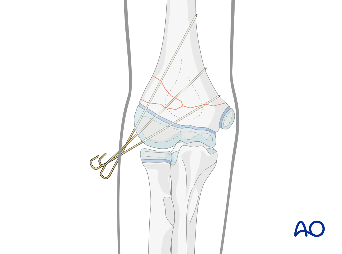 Stabiliation of a multifragmentary supracondylar fracture with 3 K-wires