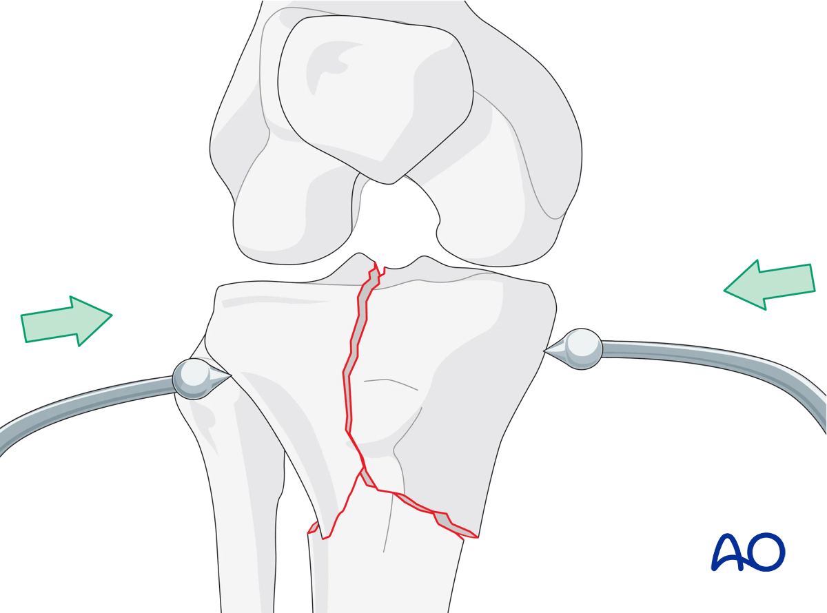 Complete simple articular fracture with simple metaphyseal components: ORIF Conventional plating – open reduction
