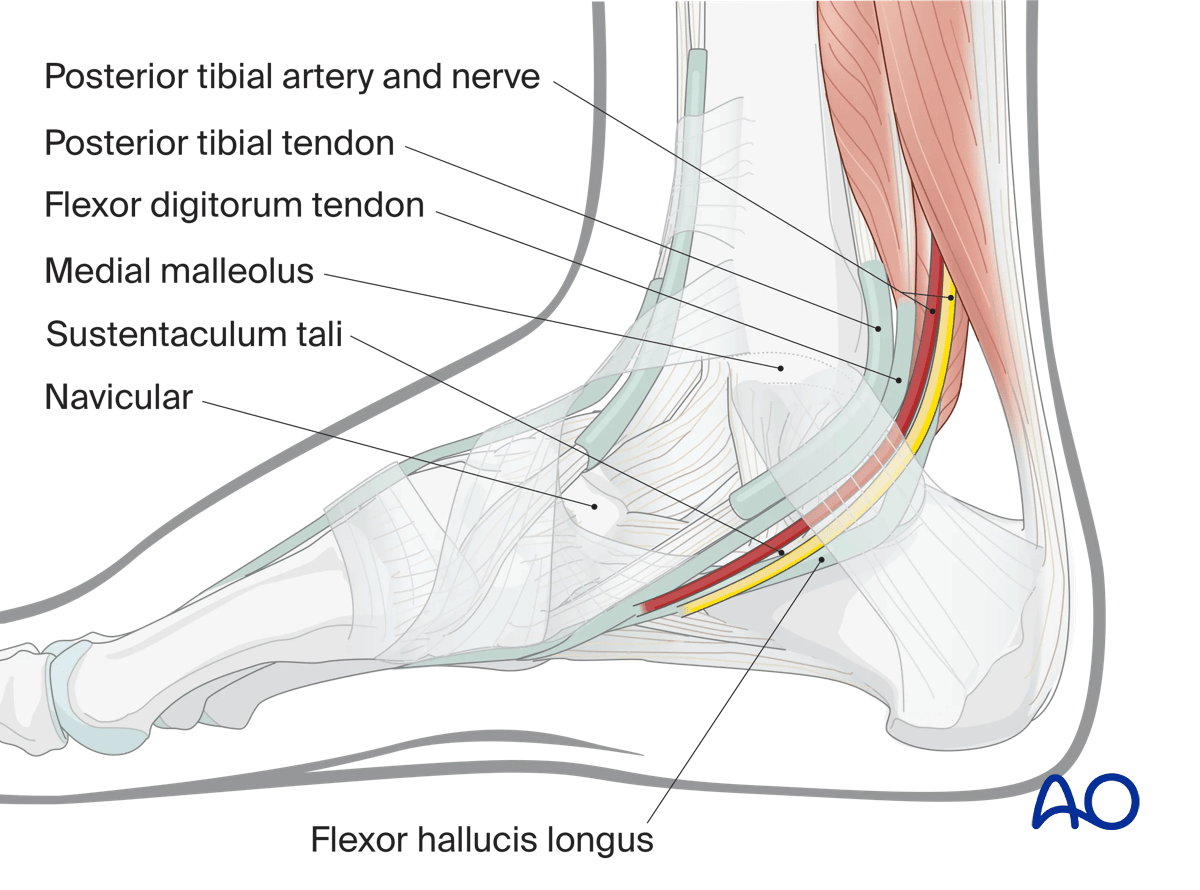 Key anatomic structures for medial approach to the calcaneus