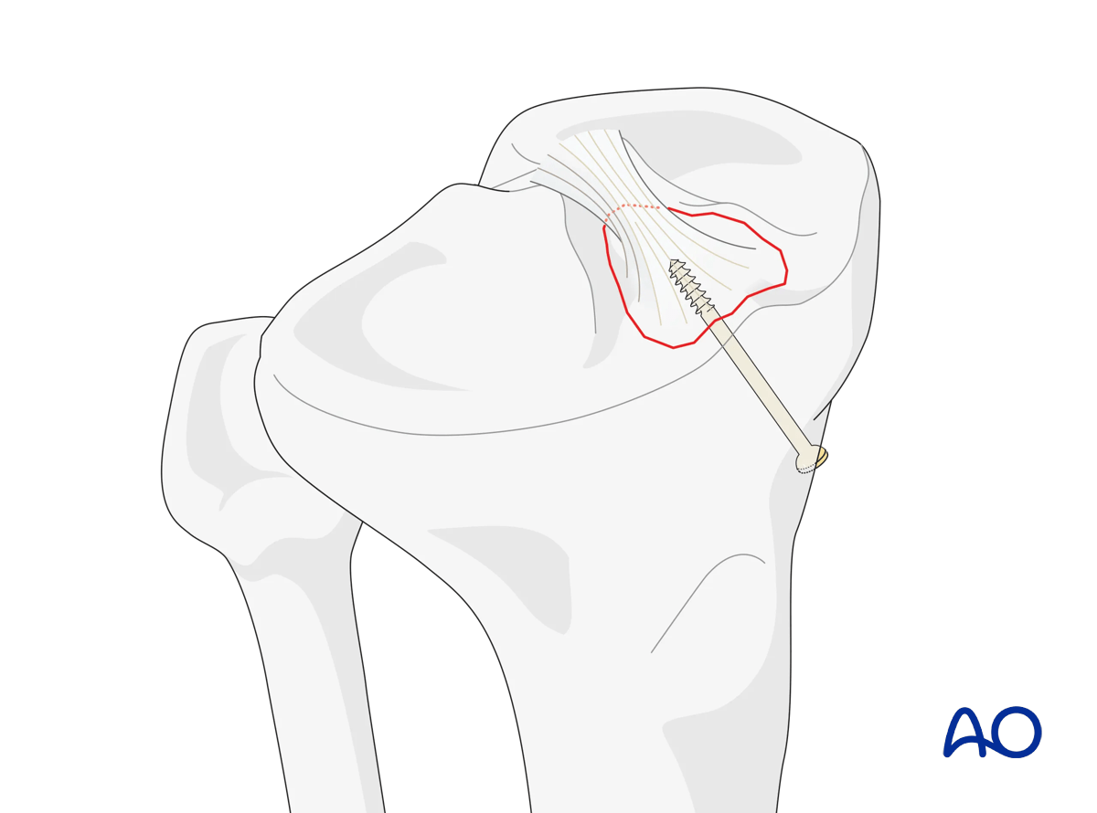 Extraarticular fracture, avulsion of tibial spine – retrograde lag screw application