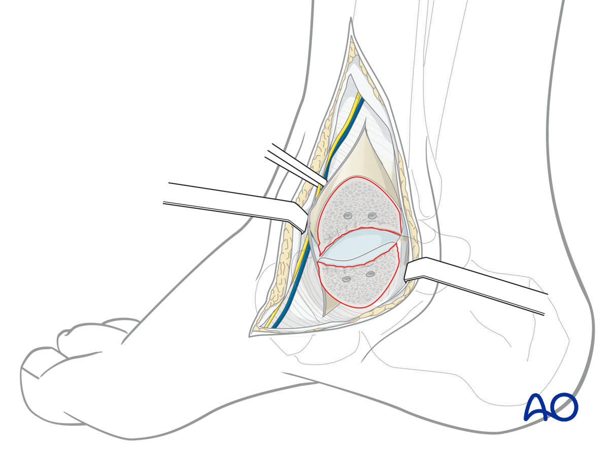 Medial malleolar osteotomy
