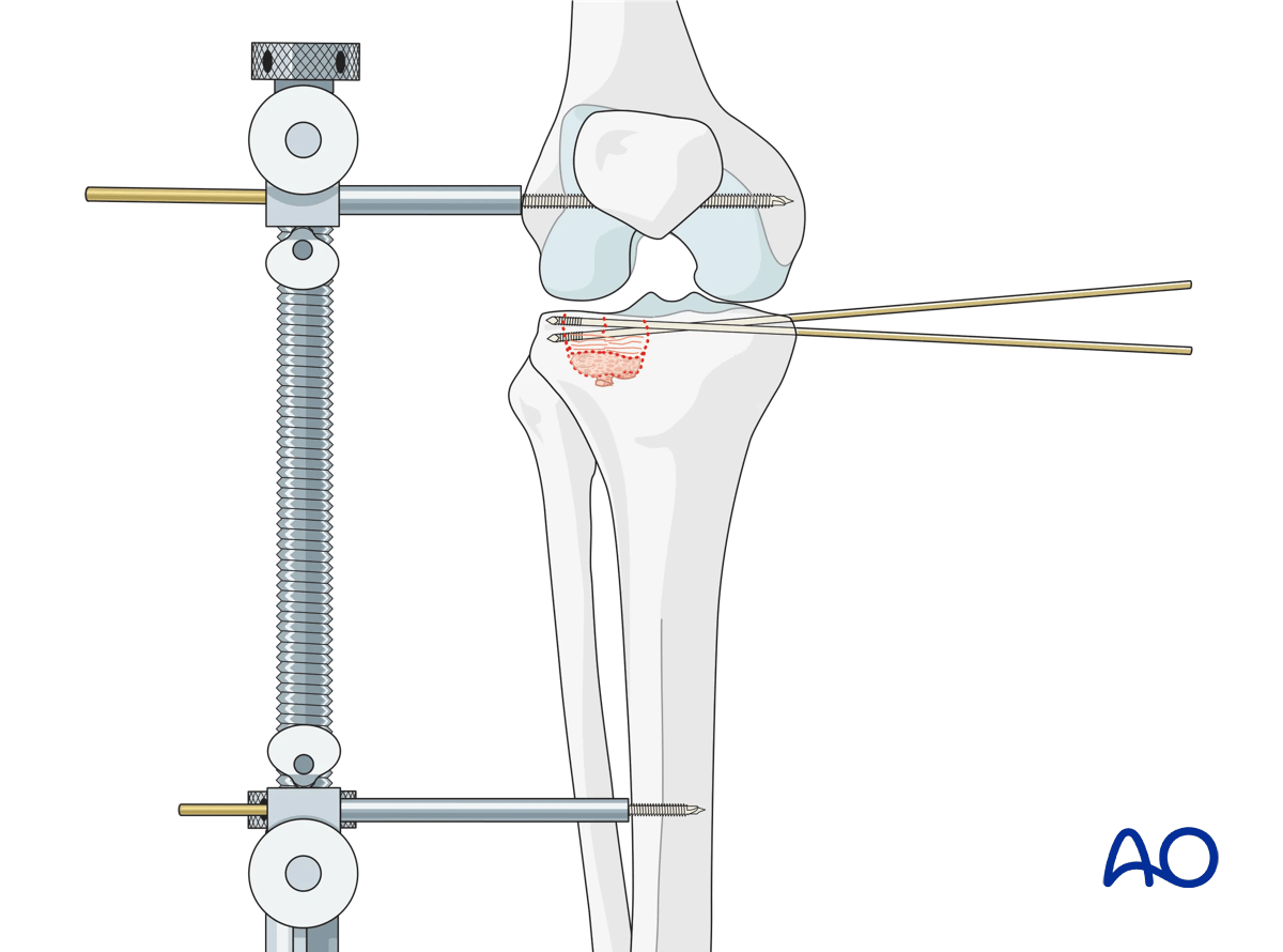ORIF - Conventional plating, reduction of the lateral articular surface