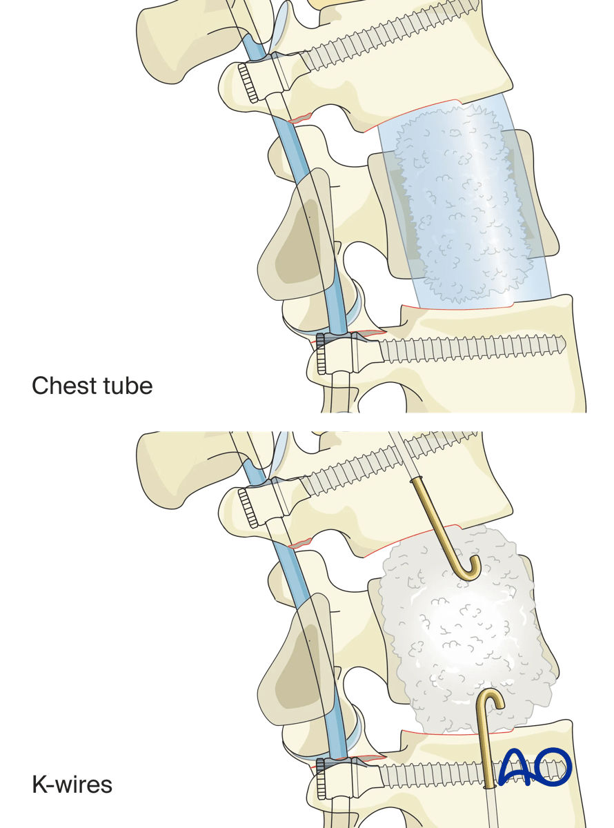 PMMA application for vertebral body reconstruction