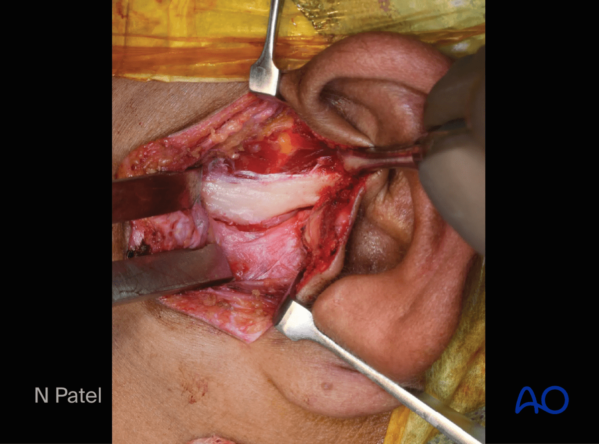 Endaural approach to condyle: The entire zygomatic arch is exposed, revealing the articular eminence and the temporomandibular joint capsule